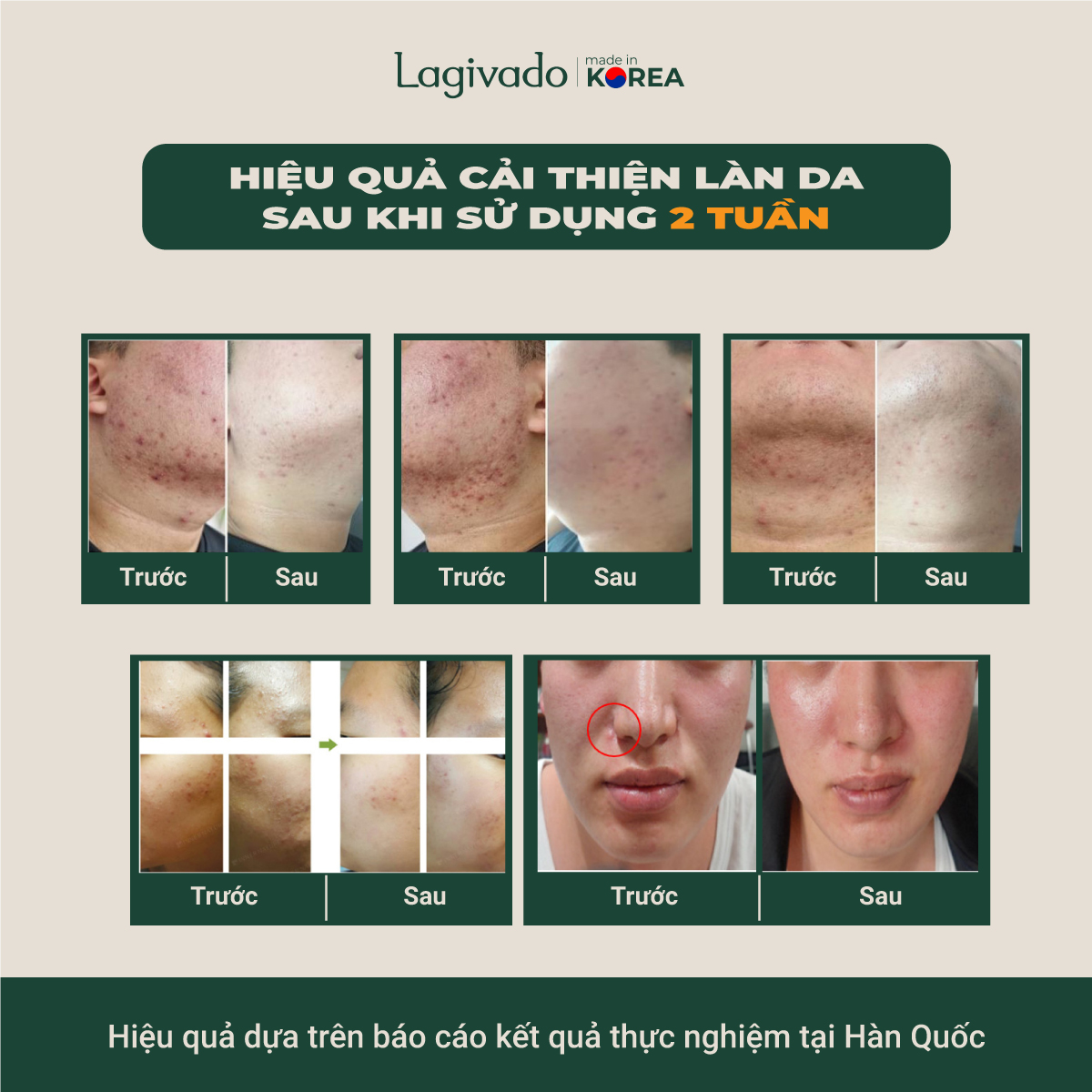 Bộ ba kem dưỡng ngăn ngừa mụn, giảm mụn viêm Lagivado Atreat Cream 30g và serum ngừa thâm, không để lại sẹo 60 ml