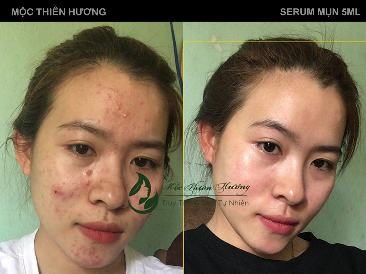 Serum 50ml Đánh Bay Mụn Thâm Nám Lâu Năm - Mộc Thiên Hương (Herbal Anti Acne Serum)