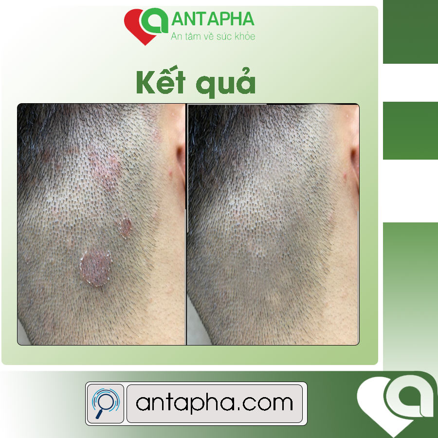 Serum Trinada nấm da đầu, gàu ngứa sạch sẽ da đầu, Antapha