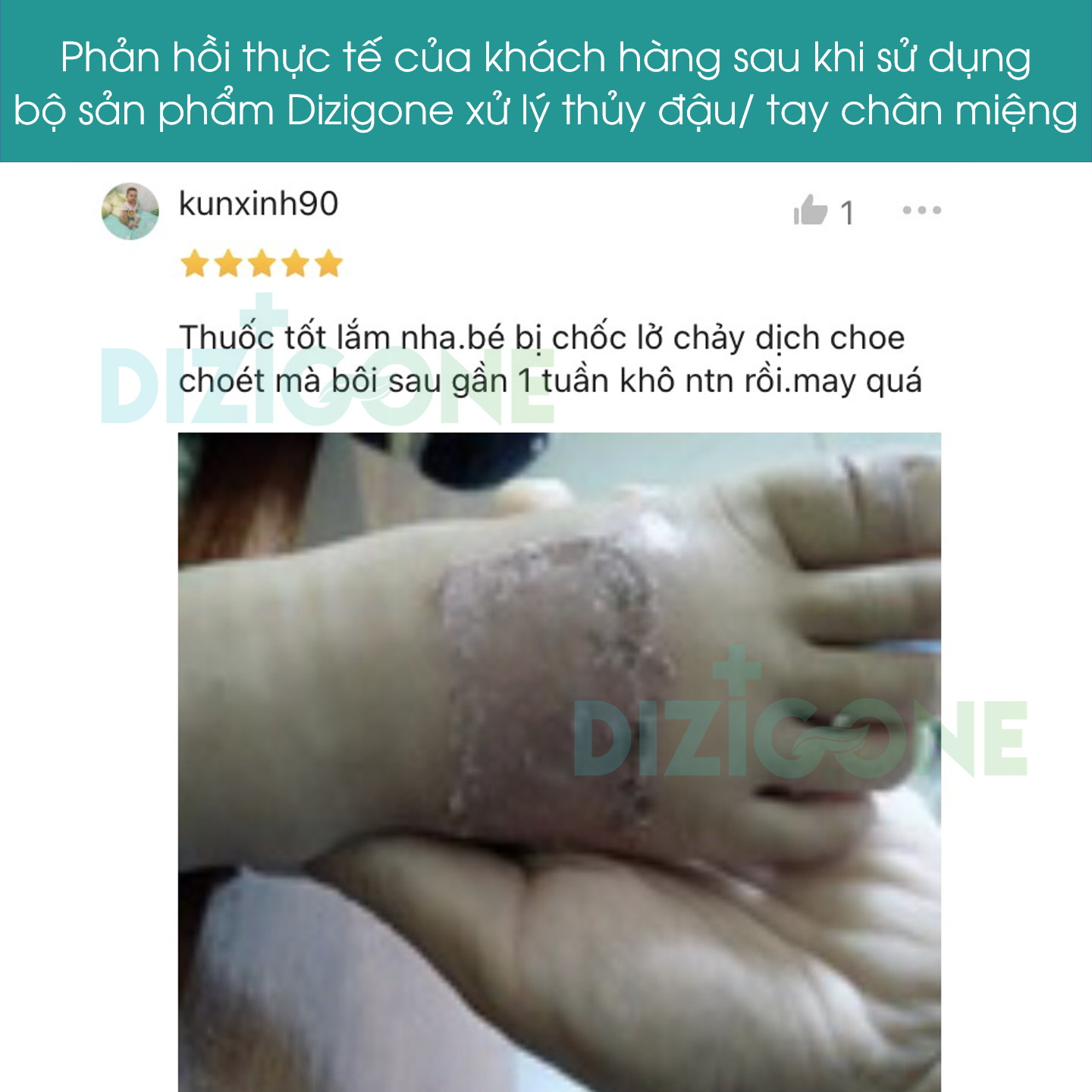 Dung dịch kháng khuẩn DIZIGONE chăm sóc tổn thương lành nhanh, không đau xót, tái tạo da, ngăn ngừa sẹo 300ml