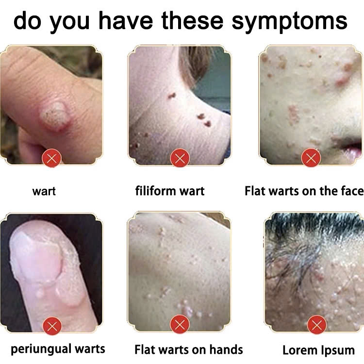 Kem Mụn Cóc, Mụn Thịt, Mụn Cơm Hiệu Quả – Chiết Xuất Thảo Dược An Toàn 20g, ĐÈN TRANG TRÍ , ĐỒNG HỒ TREO TƯỜNG