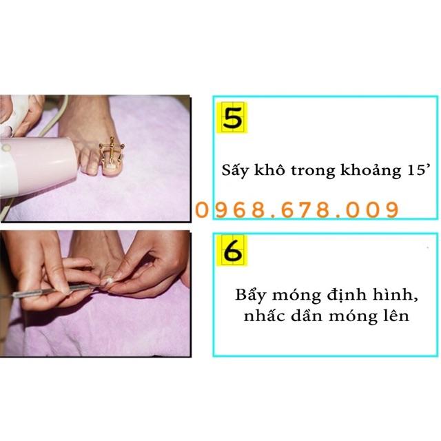 BỘ DỤNG CỤ CHỮA MÓNG CHÂN BỊ CHỌC THỊT GÂY TỔN THƯƠNG ĐAU ĐƠN -MÓNG CHÂN BỊ QUẶP THỊT