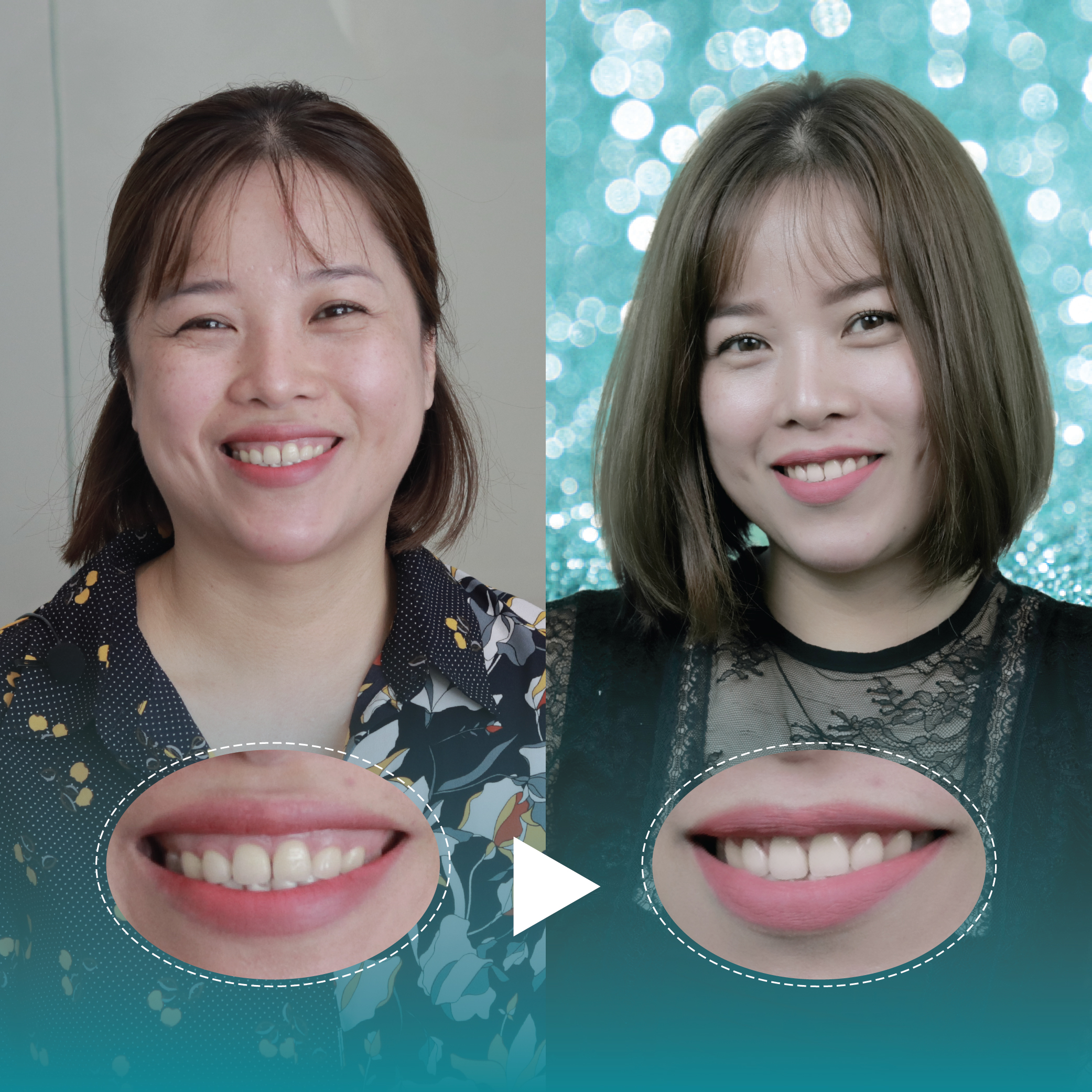 Điều trị dứt điểm hở lợi tại Nha Khoa Thẩm Mỹ Quốc Tế San Dentist