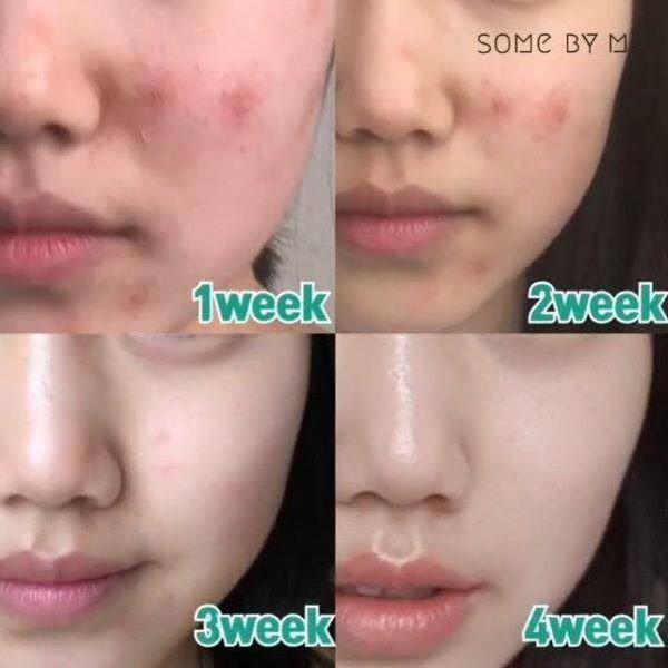 Combo 2 Sản Phẩm Hỗ Trợ Giảm Mụn, Kiểm Soát Bã Nhờn Some By Mi AHA-BHA-PHA 30 Days Miracle
