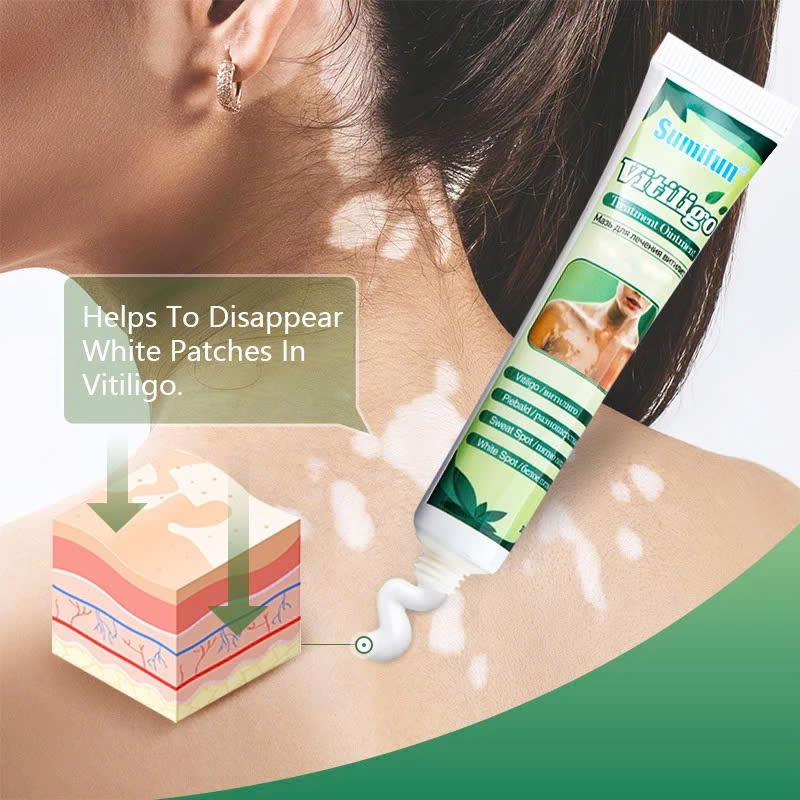 [Vilitigo] Kem Bôi Lang Ben, Hắc Lào, Nấm Ngứa, Vẩy Nến – Chiết Xuất Thảo Dược An Toàn