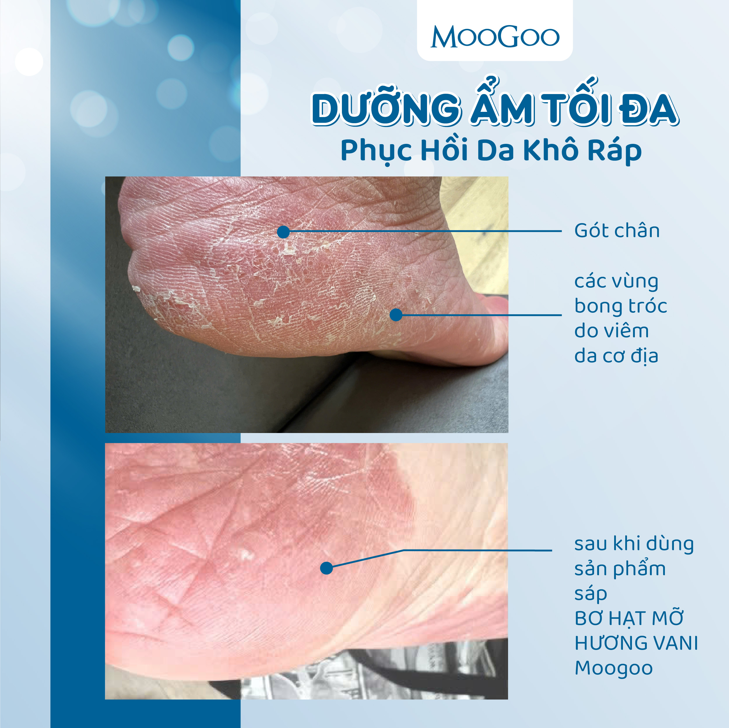Sáp chống rạn cho mẹ bầu bơ hạt mỡ dưỡng da siêu khô, nứt nẻ gót chân, da vảy nến MooGoo
