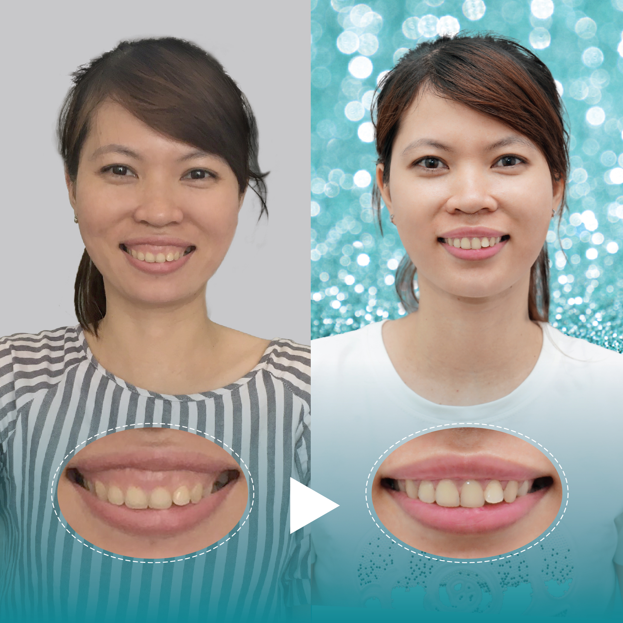 Điều trị dứt điểm hở lợi tại Nha Khoa Thẩm Mỹ Quốc Tế San Dentist