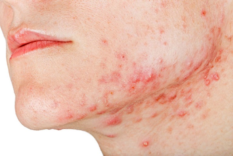 Thảo dược bôi nấm ngứa, tổ đỉa, hắc lào, lang ben, vảy nến, á sừng, zona các vấn đề về da_1 hộp 20 gói