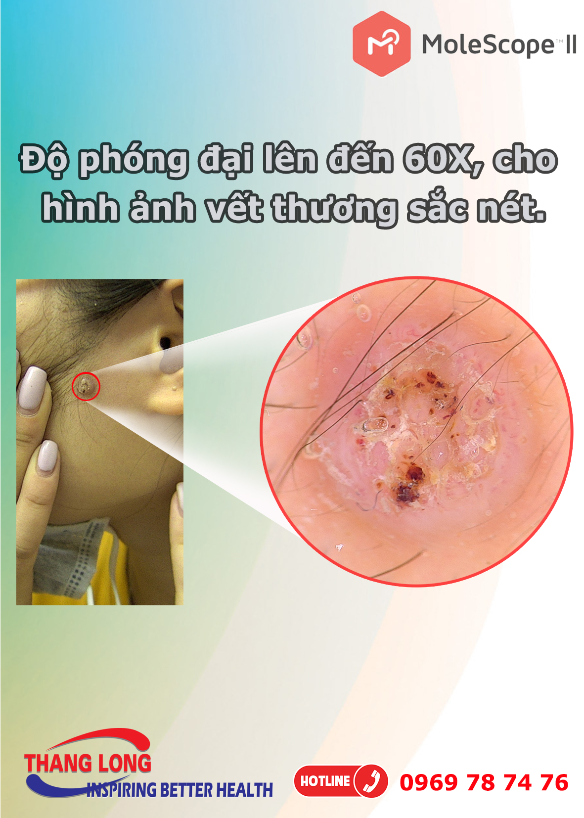 Dermoscopy - Thiết bị soi da tích hợp điện thoại và máy tính bảng MoleScope II