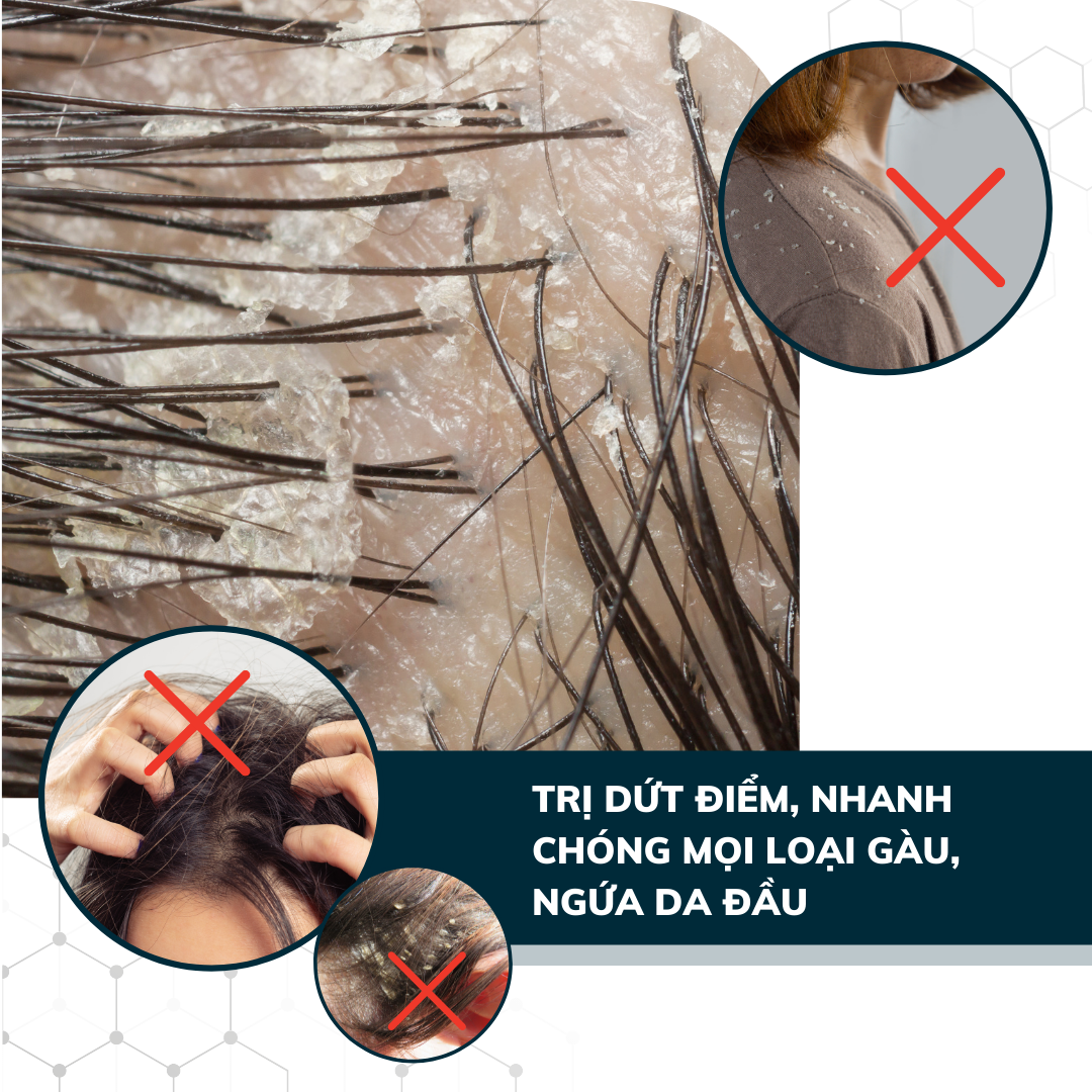 Dego Pharma - Dầu gội sạch vảy gàu mảng trắng, hết ngứa chiết xuất thiên nhiên từ vỏ cây Zizyphus, sản xuất theo tiêu chuẩn và dưới sự giám sát của công ty dược phẩm Châu Âu