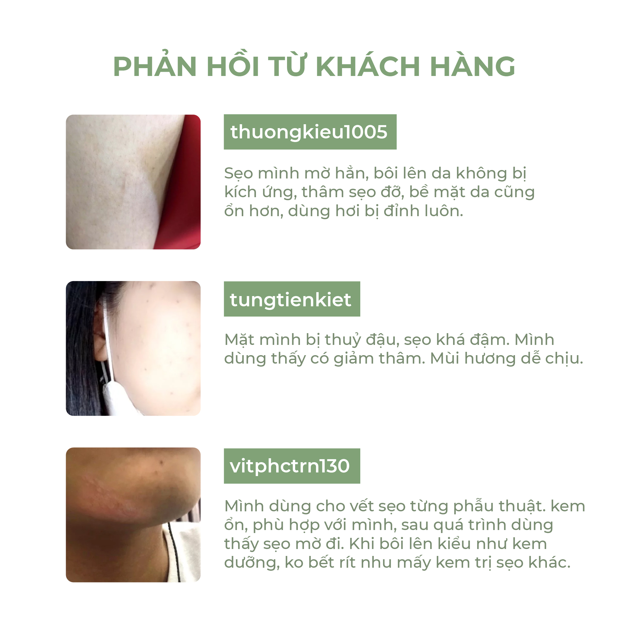 [Combo 2] Kem Sẹo Nghệ Đỏ Abera Scar 20g Phục Hồi Làn Da bị Sẹo An Toàn Hiệu Quả, Nhanh Chóng