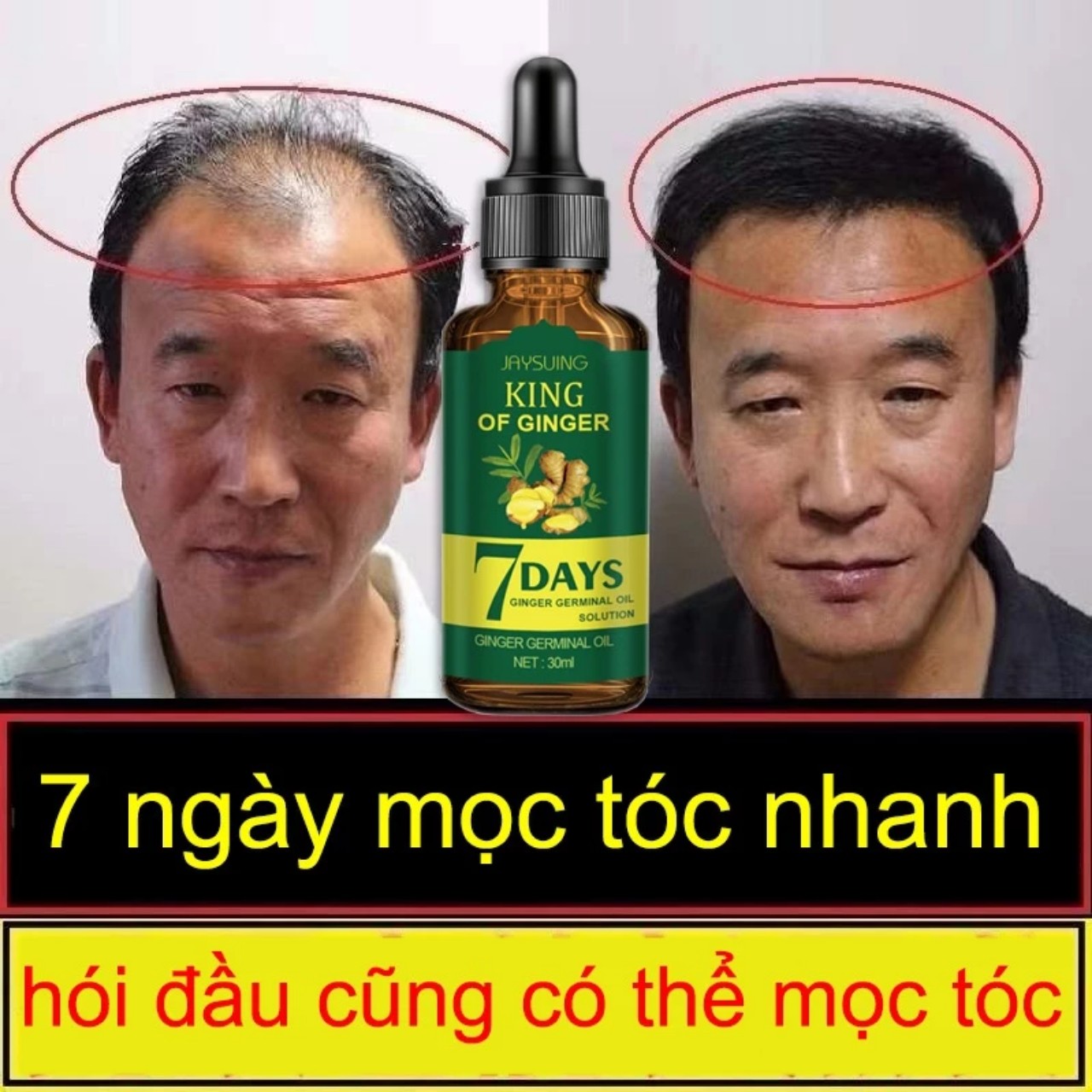 Mọc Tóc Mạnh Mẽ với Tinh Dầu Xịt ELHOE: Tinh Chất Nhân Sâm và Gừng Tươi Hiêu Qủa Sau 7 Ngày