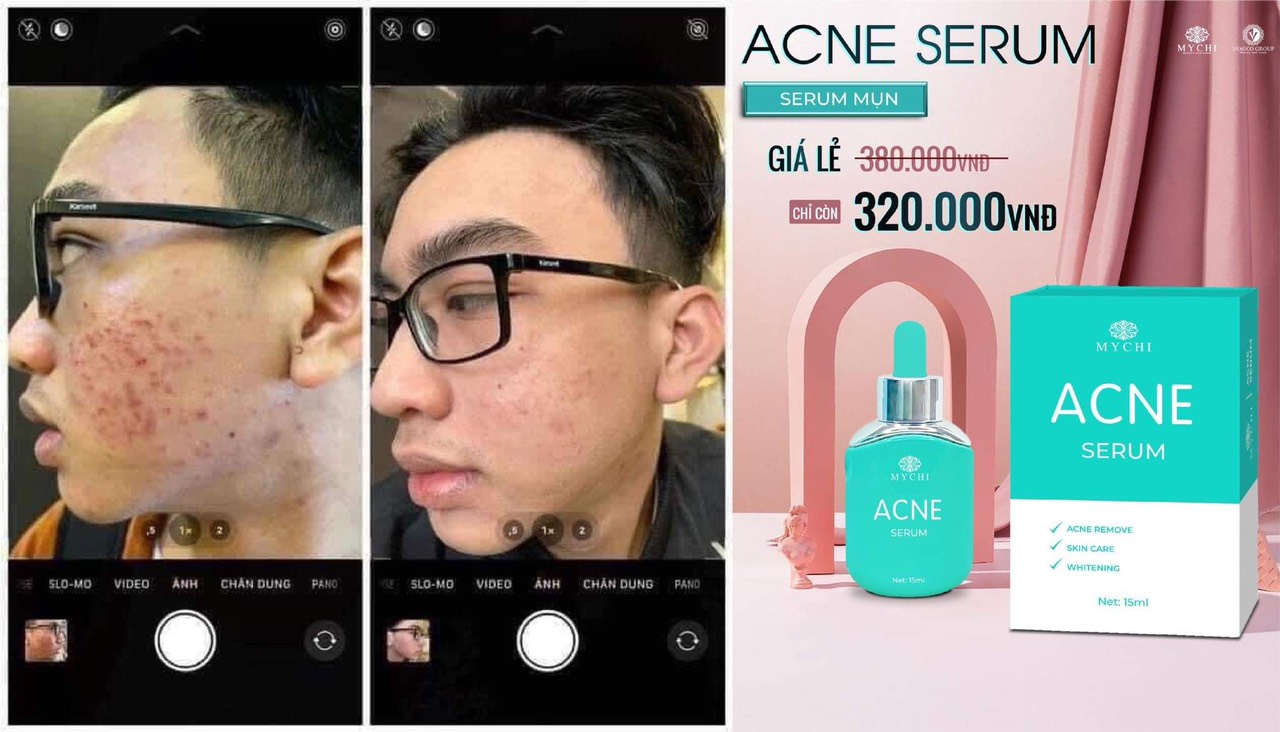 Serum mụn ACNE Mychi