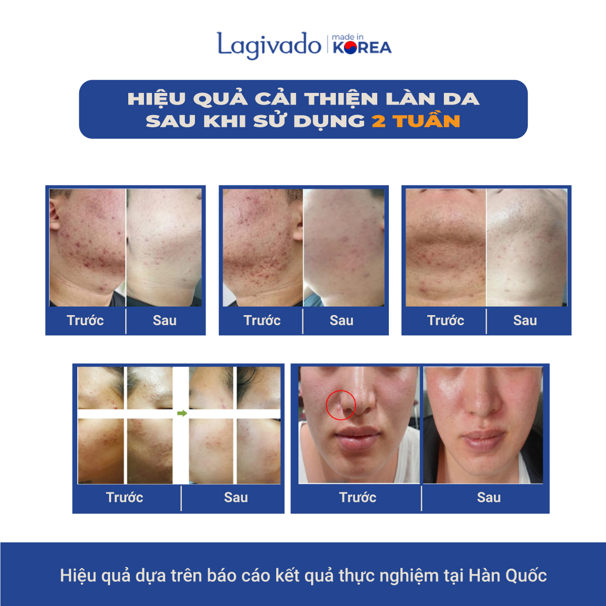 Kem chấm giảm mụn Hàn Quốc Lagivado ngừa thâm sẹo rỗ, thông thoáng lỗ chân lông Dr. Atreat Cream 30 ml