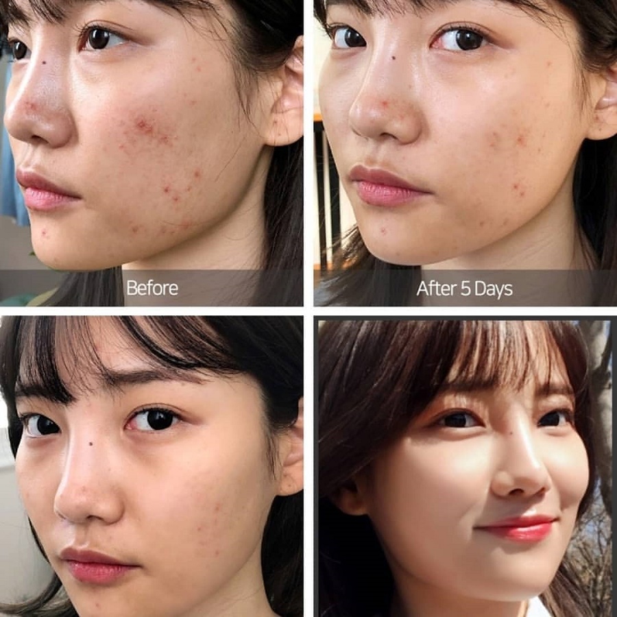 Kem Dưỡng Ngừa Mụn "14 Ngày" Some By Mi AHA/BHA/PHA 14 Days Super Miracle Spot All Kill Cream 30ml