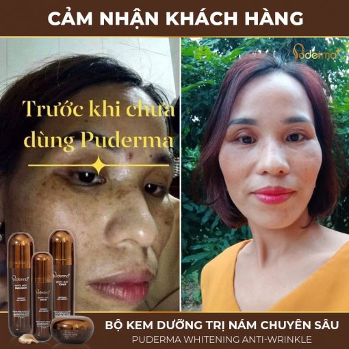 Kem Xóa NÁM WHITE JADE PUDERMA 50ml: làm mờ vết thâm sạm, nám, tàn nhang từ sâu bên trong, giúp làn da trắng sáng, căng bóng, nâng cơ săn chắc và đẩy lùi quá trình lão hoá cũng như làm mềm da nhanh chóng.