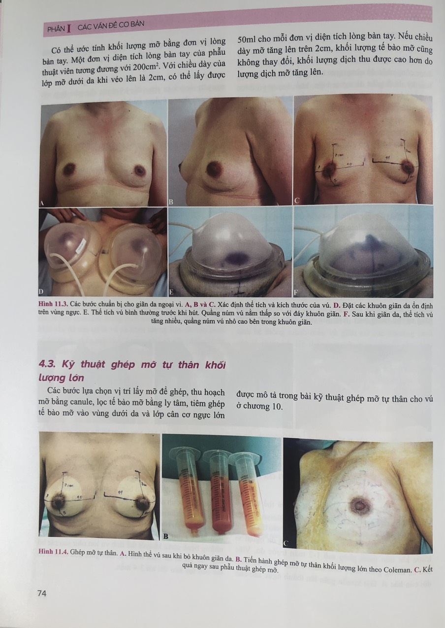 Sách - Atla.s Phẫu thuật tạo hình thảm mỹ vú(Tập 1)