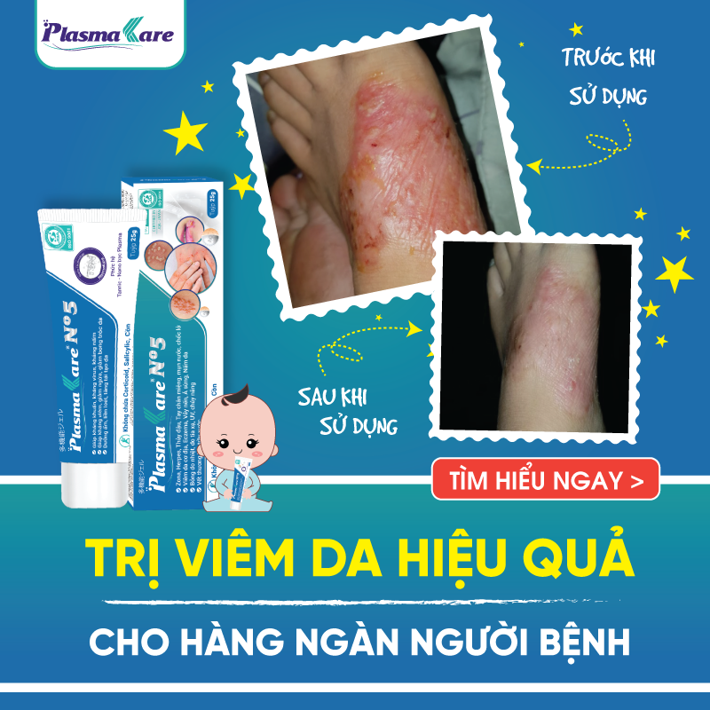 Kem bôi da Nano bạc cho viêm da cơ địa, viêm da tiếp xúc, muỗi và côn trùng đốt Plasmakare No5