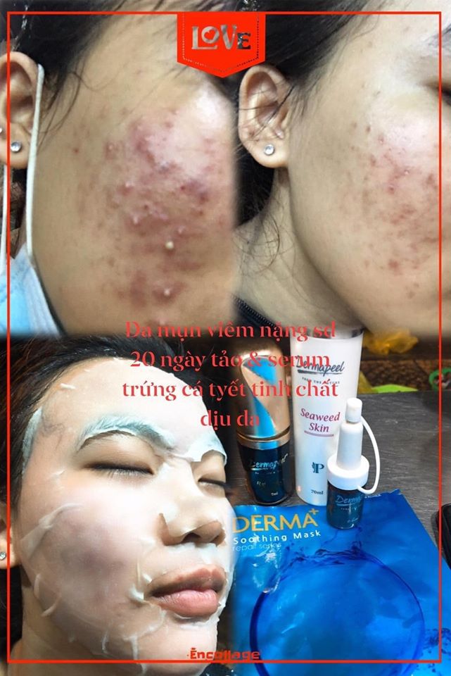 Vi kim tảo biển trứng cá tuyết Derma peel+ Skincare Total Solution - Vì Làn Da Hoàn Hảo