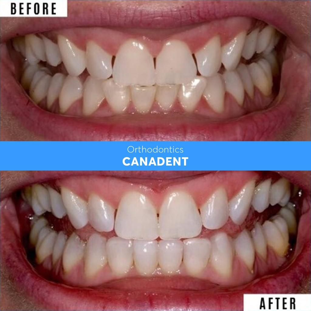 BỘ 3 NIỀNG RĂNG SILICON CANADENT ALIGNMENT.