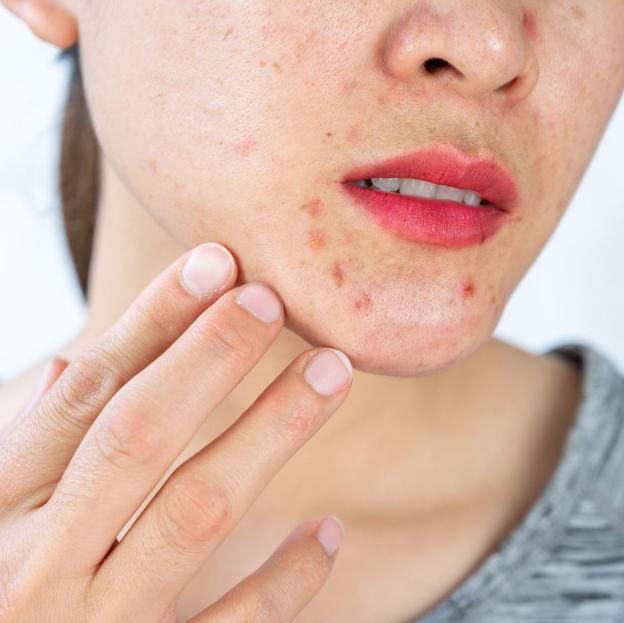 Thảo dược bôi nấm ngứa, tổ đỉa, hắc lào, lang ben, vảy nến, á sừng, zona các vấn đề về da_1 hộp 20 gói