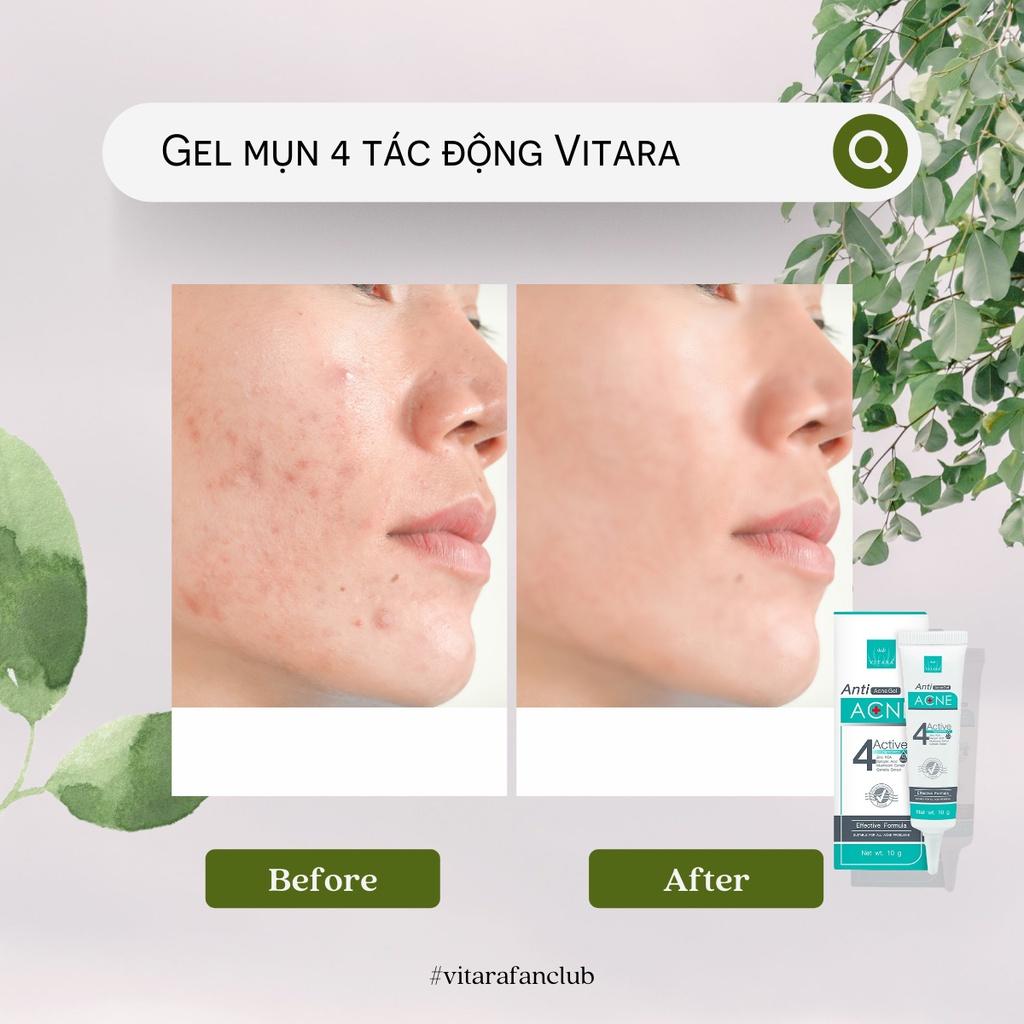 Gel thoa mụn Vitara Anti Acne làm lành vết thương do mụn, ngừa thâm mụn 10g