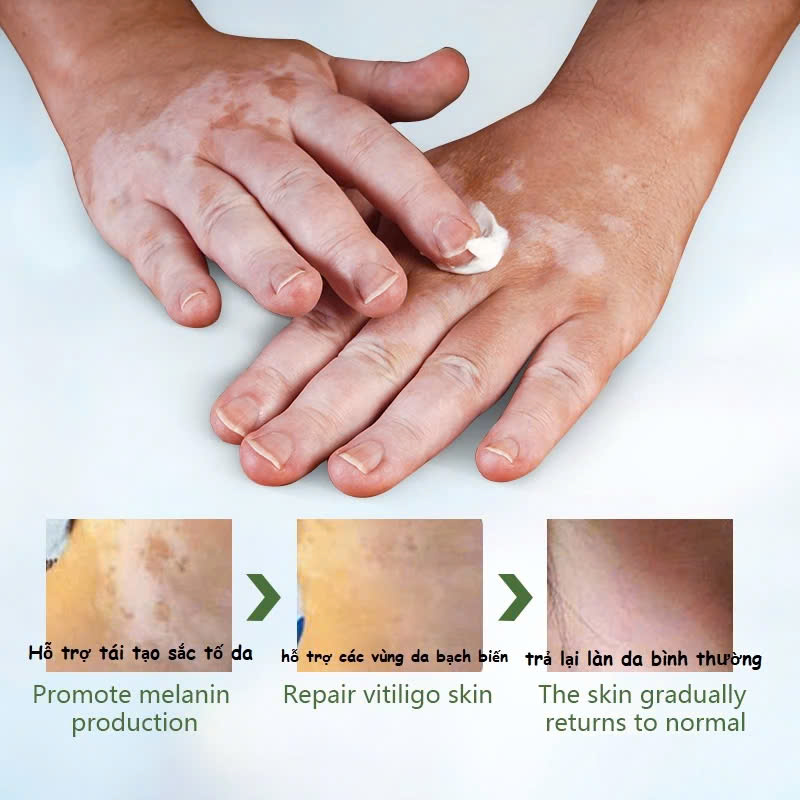 [Vilitigo] Kem Bôi Lang Ben, Hắc Lào, Nấm Ngứa, Vẩy Nến – Chiết Xuất Thảo Dược An Toàn