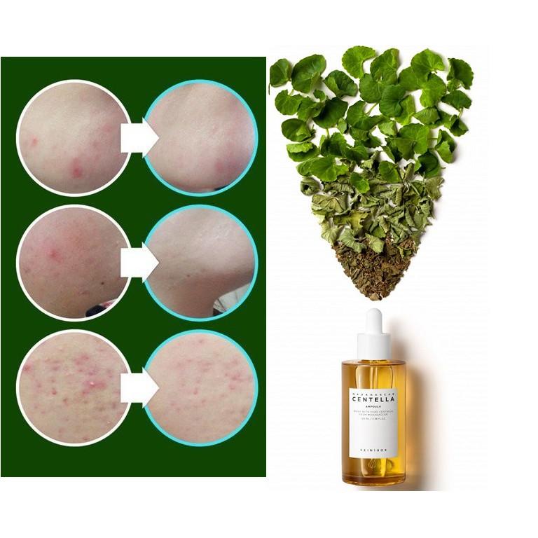 Combo Tinh Chất và Kem Rau Má Làm Dịu Da Mụn, Phục Hồi Da Skin1004 Madagascar Centella Asiatica