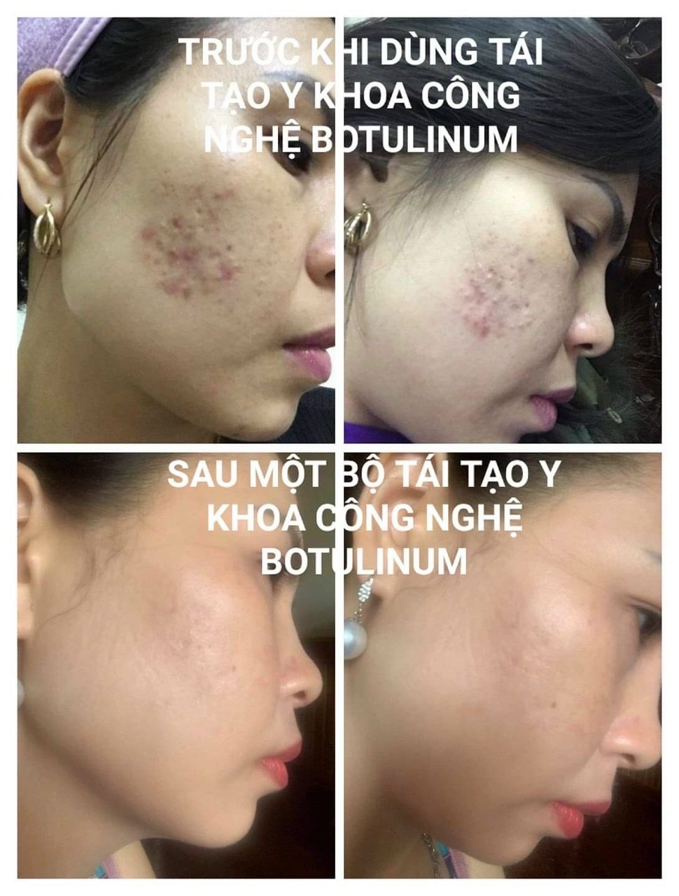 BỘ SIÊU TÁI TẠO NÂNG CƠ TRẺ HÓA Y KHOA, LÀM ĐẦY NẾP NHĂN, CĂNG BÓNG DA TOÀN DIỆN REVITALIZE 1.0 BOTULINUM  (LT LUXURY BOTULINUM AGE REWIND SOLUTION)