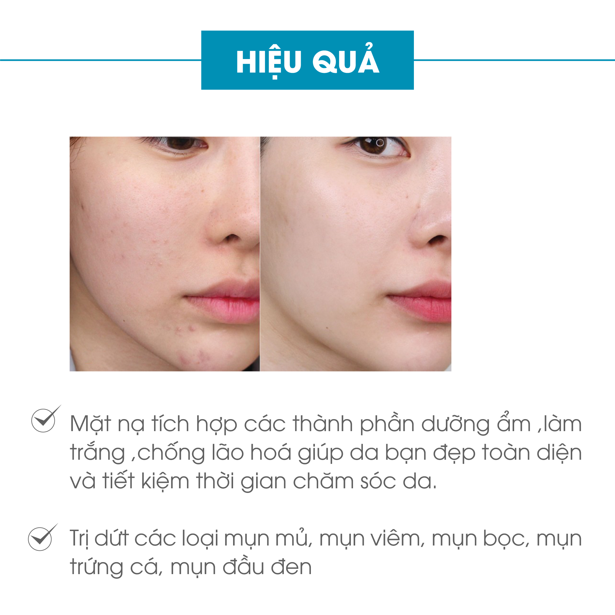 Bộ ngừa mụn da mặt Truesky Premium M01 gồm 1 serum ngừa mụn tràm trà 20ml + 3 miếng mặt nạ giấy tế bào gốc Truesky