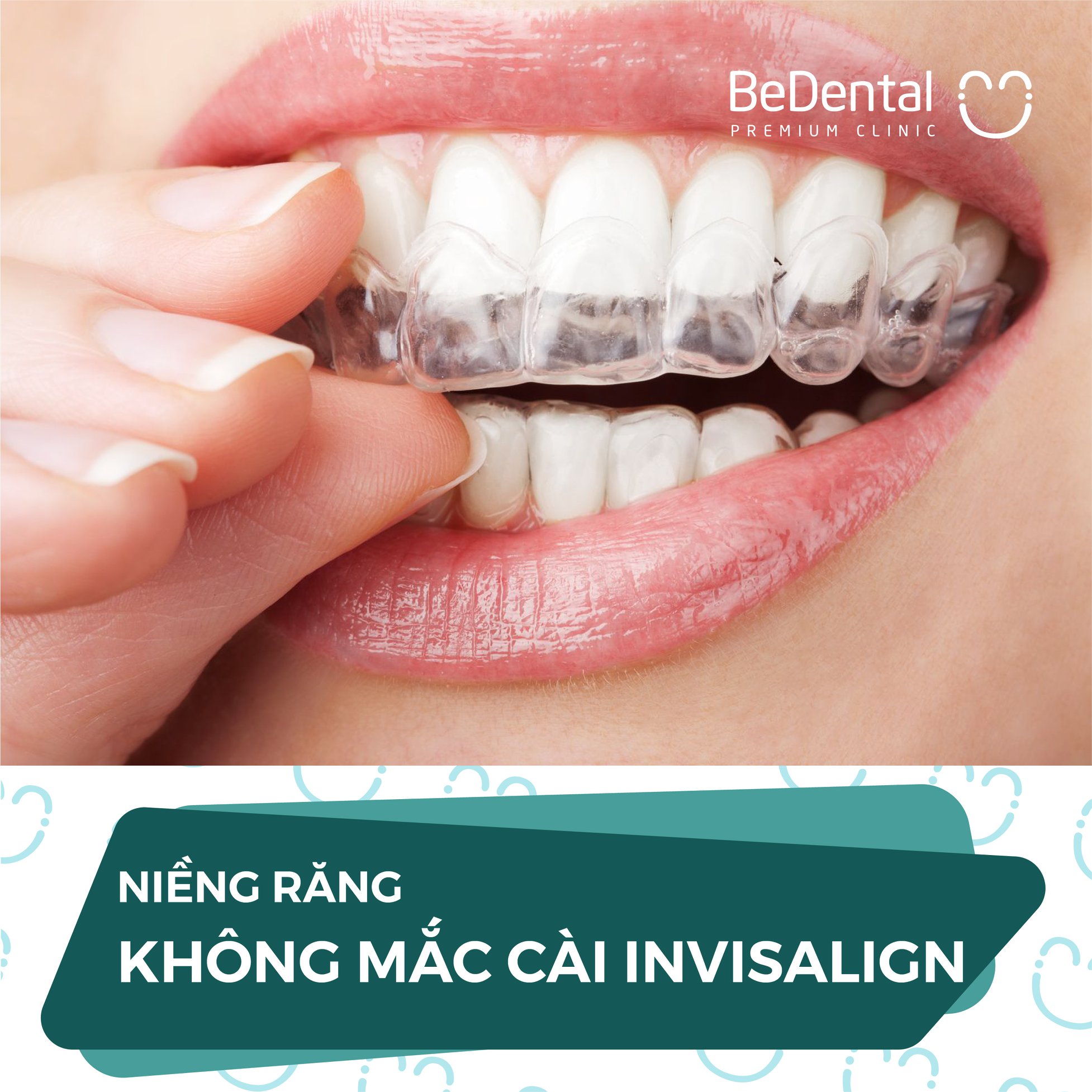 Voucher Niềng răng - Nha khoa BeDental - 5 chi nhánh