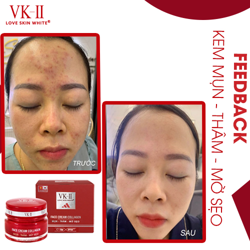 Kem Ngừa Mụn Thâm Sẹo VK II