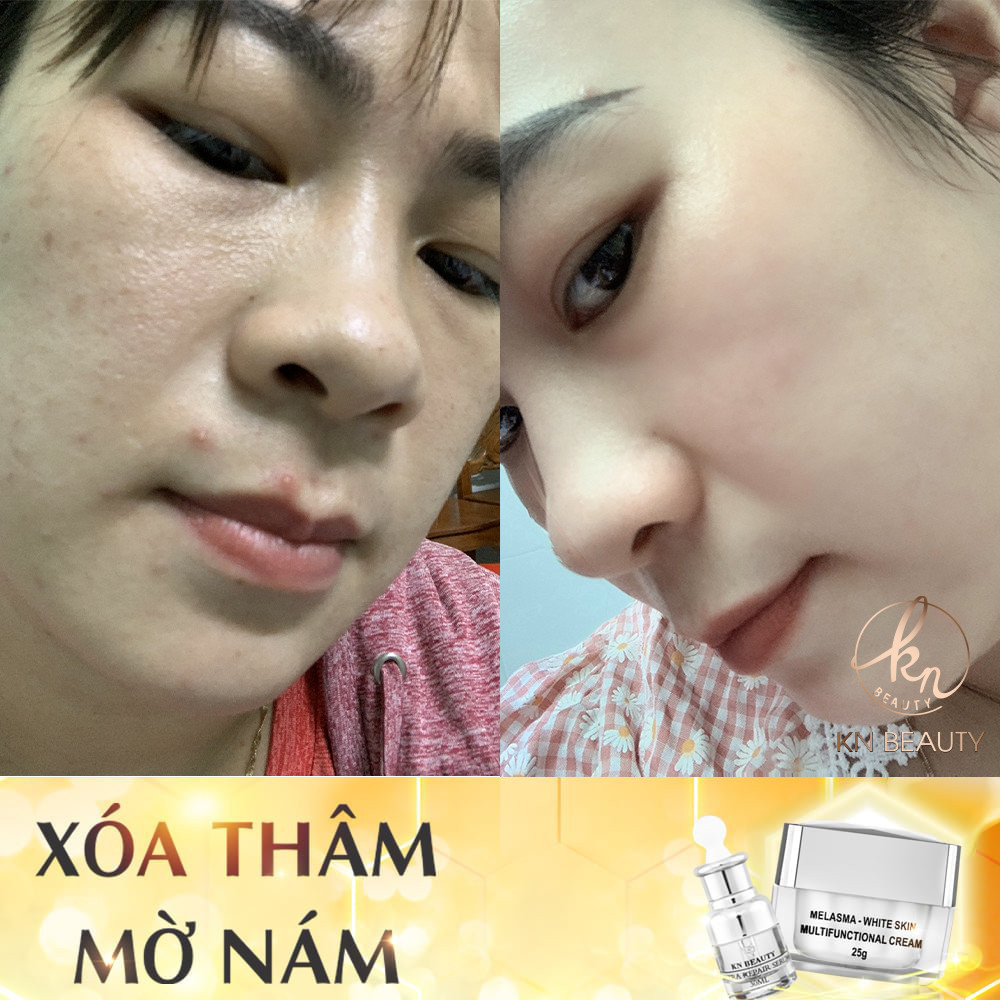 Bộ 2 Kem Xóa Mờ Thâm Nám, Tàn Nhang, Đồi Mồi, Trắng Da, Chống Nắng KN Beauty 25g - KN Beauty Cosmetics