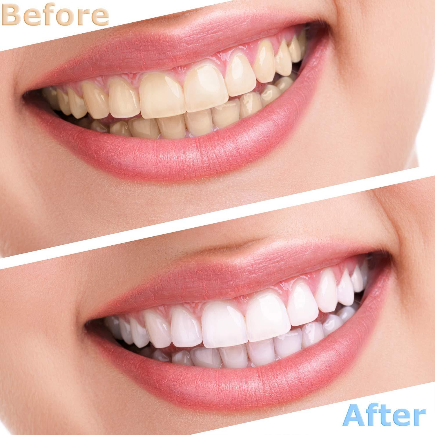 Đặt với 3 cặp răng giả tạm thời để làm trắng răng giả bằng chân giả cho các bộ phận giả tạm thời