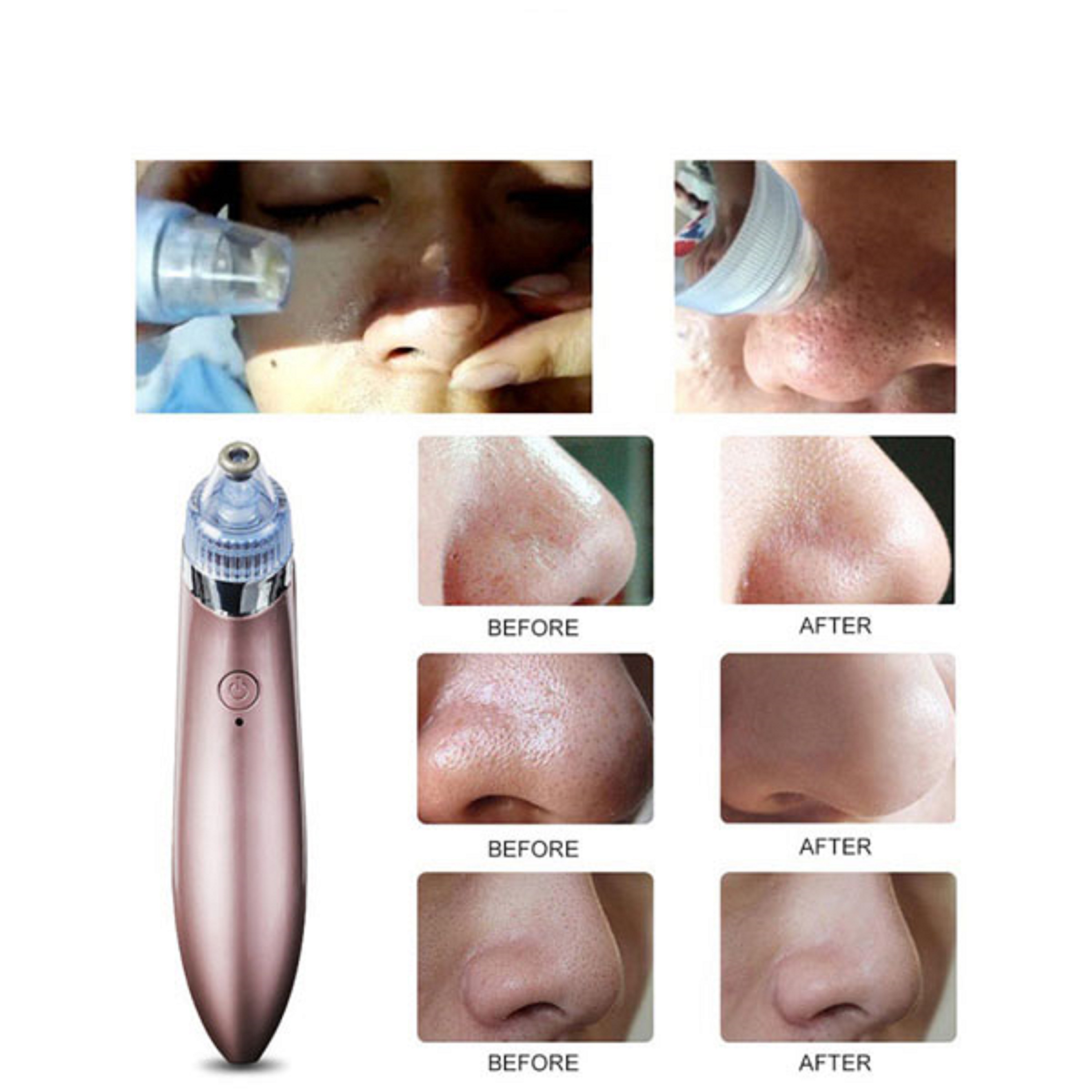 Máy Hút Mụn cầm tay, hút mụn đầu đen, bã nhờn, mụn cám, trứng cá Beauty Skin Care XN-8030 với nhiều đầu hút tiện lợi tại nhà