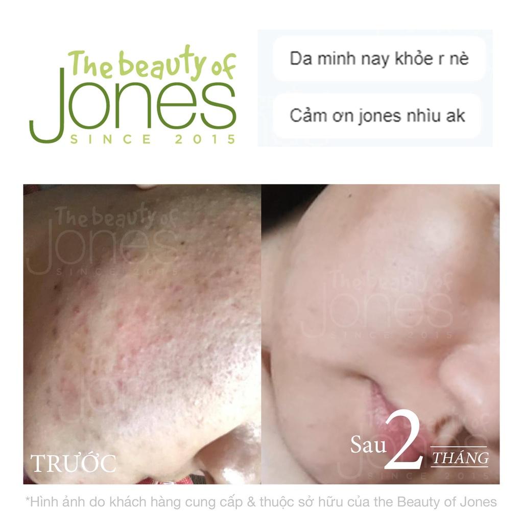 Kem ngừa mụn dành cho mẹ bầu The Beauty of Jones 20gr và 5gr