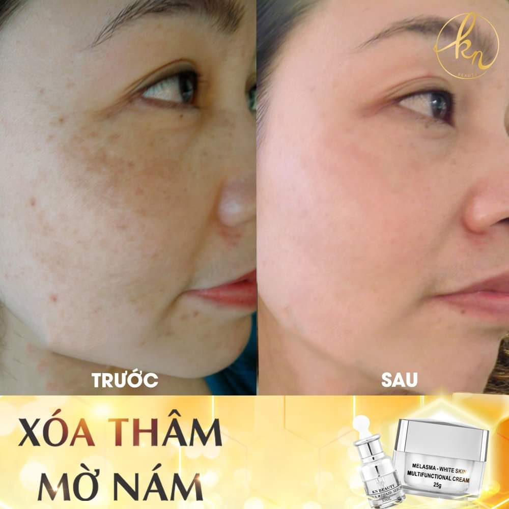 Bộ 2 Kem Xóa Mờ Thâm Nám, Tàn Nhang, Đồi Mồi, Trắng Da, Chống Nắng KN Beauty 25g - KN Beauty Cosmetics