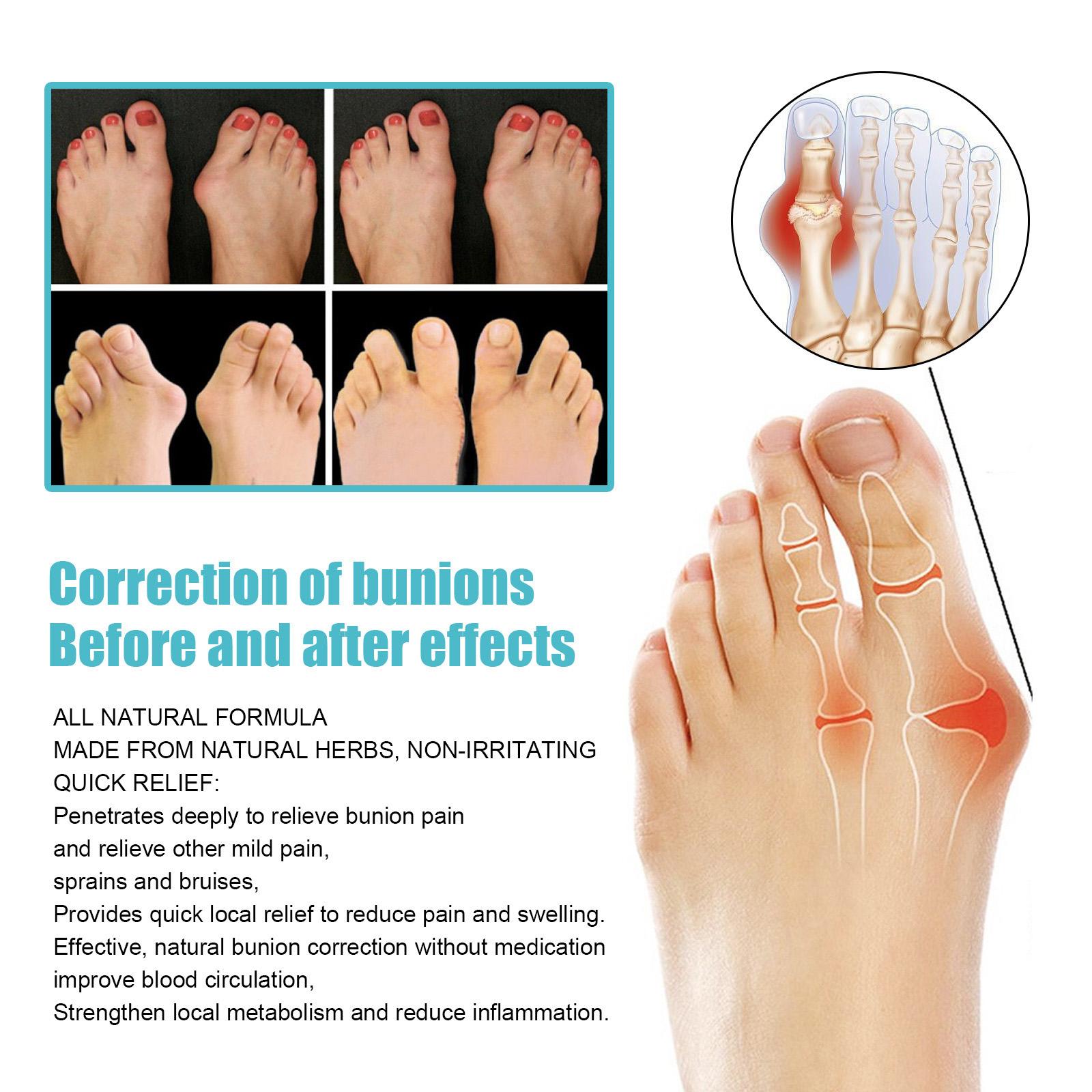 South Moon 8PCS Bunion Patch Relief Bunion Swelling Pain Patch Correction Foot Care Patch