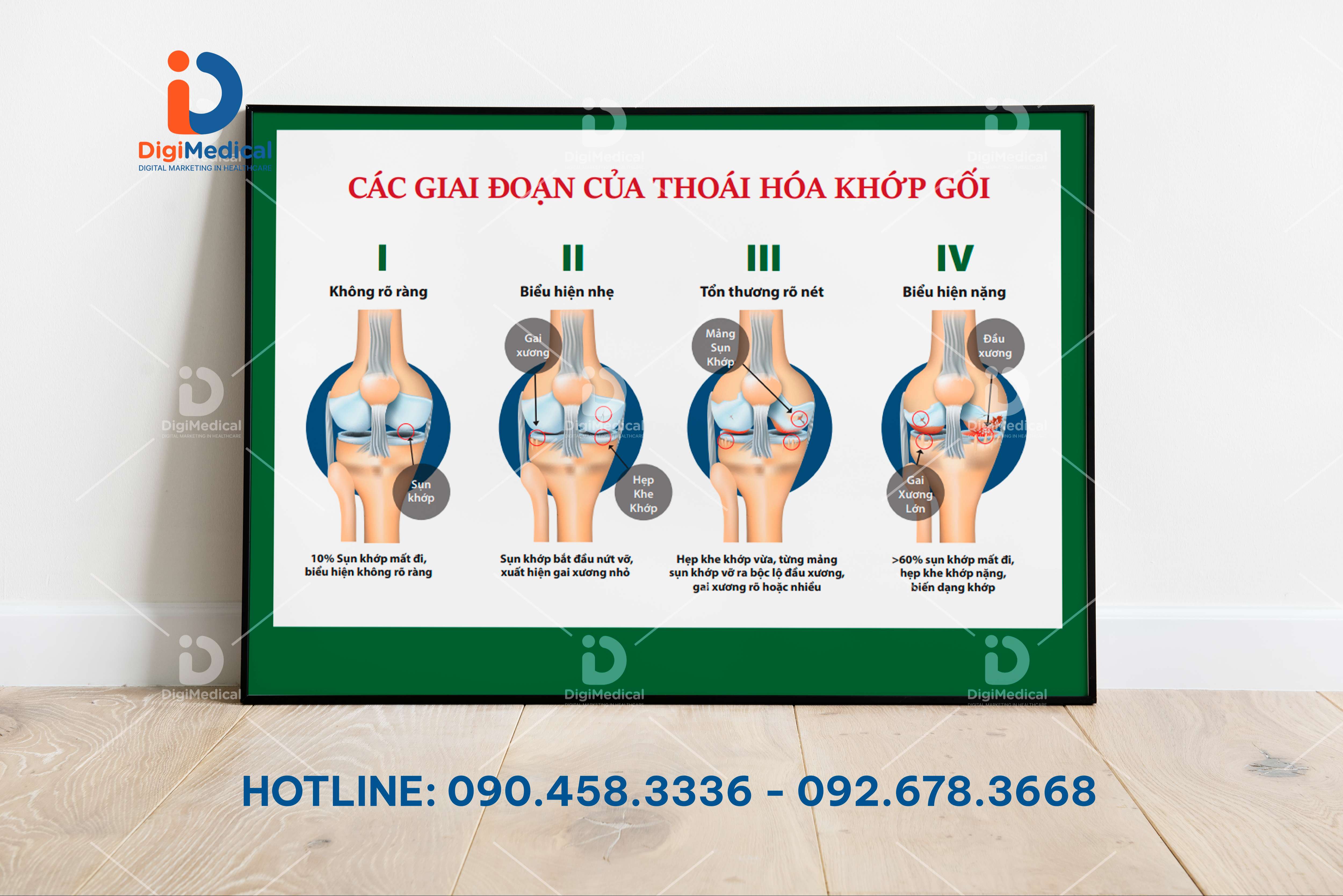 (Decal Dán) Tranh Xương Khớp: Các Giai Đoạn Của Thoái Hóa Khớp Gối