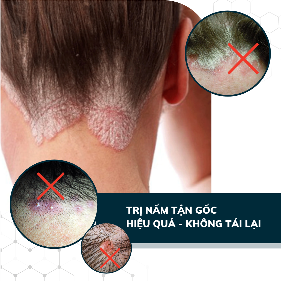 Dego Pharma - Dầu gội sạch vảy gàu mảng trắng, hết ngứa chiết xuất thiên nhiên từ vỏ cây Zizyphus, sản xuất theo tiêu chuẩn và dưới sự giám sát của công ty dược phẩm Châu Âu