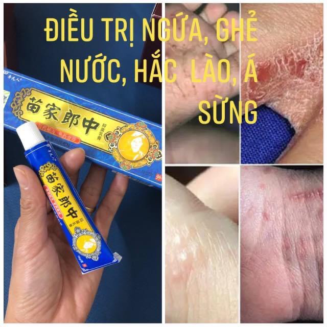 Kem bôi  hỗ trợ điều trị ngứa, vảy nến, á sừng, nứt chân 15 gram