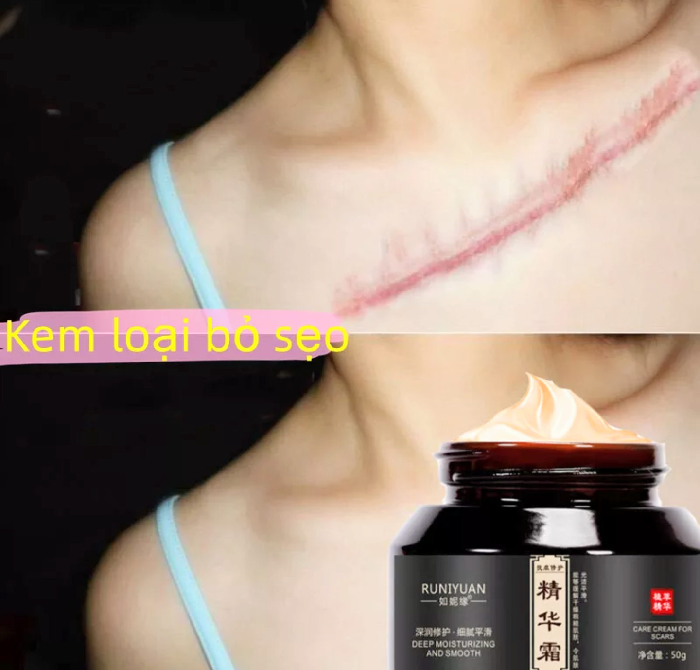 KEM TRỊ XÓA LÀM MỜ CÁC VẾT SẸO TRÊN DA HOÀN TOÀN NHANH CHÓNG HIỆU QUẢ CAO LOẠI TỐT NHẤT HIỆN NAY