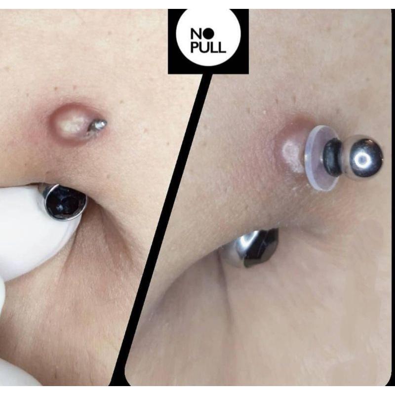 MIẾNG Nopull Disc / Miếng Nẹp Bump - Nẹp bump / Đệm siết
