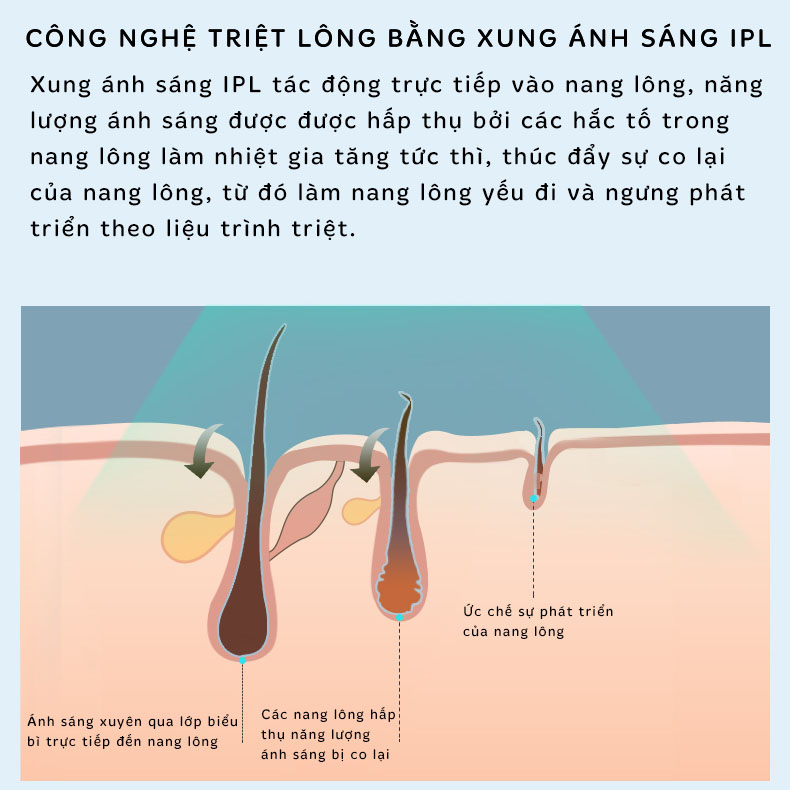 Máy Triệt Lông Vĩnh Viễn Qmele 301-S, Công Nghệ Làm Lạnh Đầu Triệt, Triệt Mát Lạnh, Không Nóng Rát