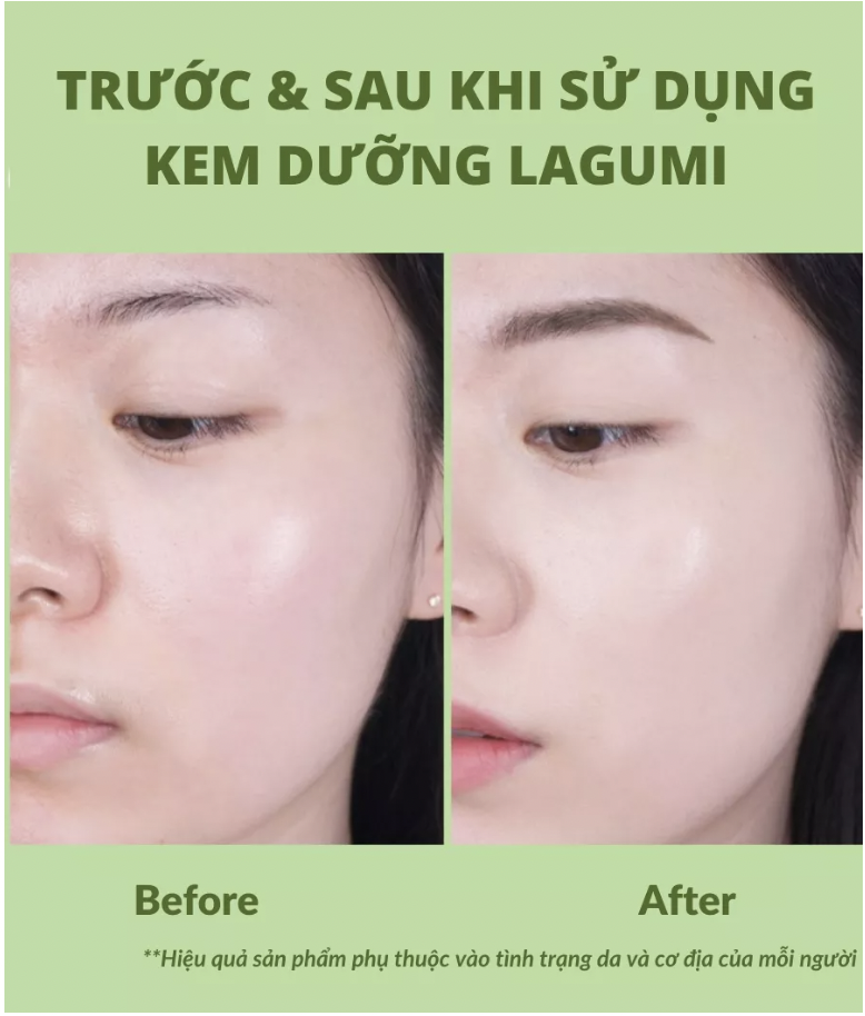 Kem dưỡng Lagumi cho da dầu, mụn với B5, Calendula cấp ẩm, giảm mụn, giảm thâm an toàn cho mẹ bầu và sau sinh