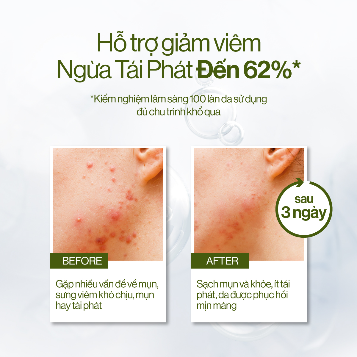 Nước Cân Bằng Khổ Qua + B5 Gilaa Blemish Repair giúp Điều Tiết Dầu Thừa Giảm Mụn140ml