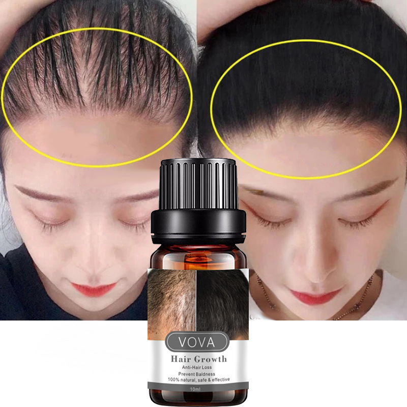 Serum mọc tóc, chống hói, chống rụng, chống gãy tóc, thành phần tự nhiên an toàn và tiện dụng