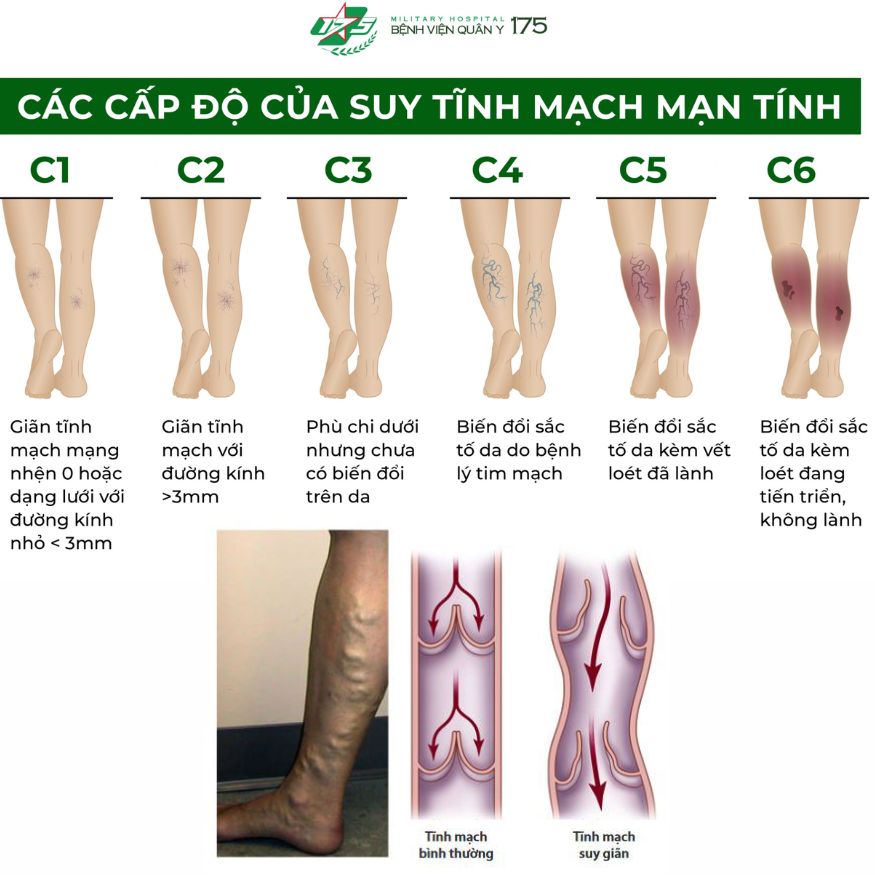 Máy nén ép trị liệu suy giãn tĩnh mạch chân Kachi MK394 - Hàng chính hãng