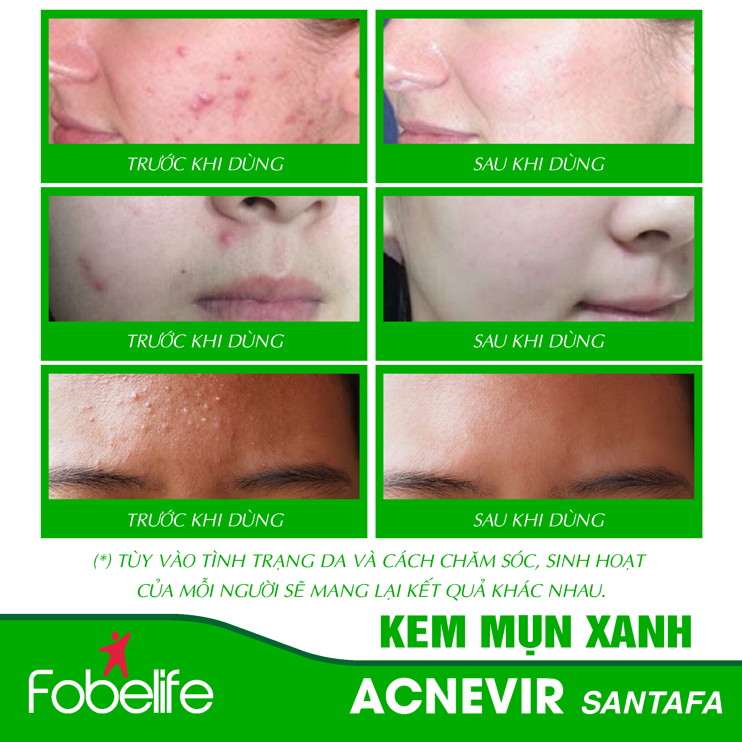 Kem Hỗ Trợ Giảm Mụn Mủ Mụn Viêm Mụn Bọc Acnevir Santafa xanh ( Tuýp 10gr )