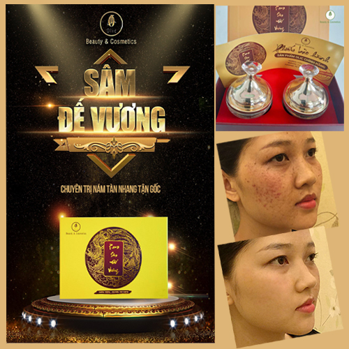 Bộ sản phẩm KEM SÂM ĐẾ VƯƠNG OLIC chống lão hóa da cao cấp, Xóa thâm da, sạm da, làm sạch tàn nhang trên da còn làm trắng da, trẻ hóa làn da, lấy lại tuổi thanh xuân.